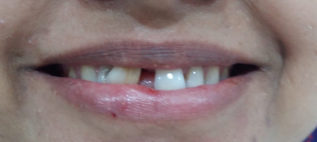 Cosmetic dentistry smile design pre 1 Dr Ahuja Dental and Implant Clinic Indirapuram Vaishali Vasundhara Ghaziabad Noida Delhi NCR