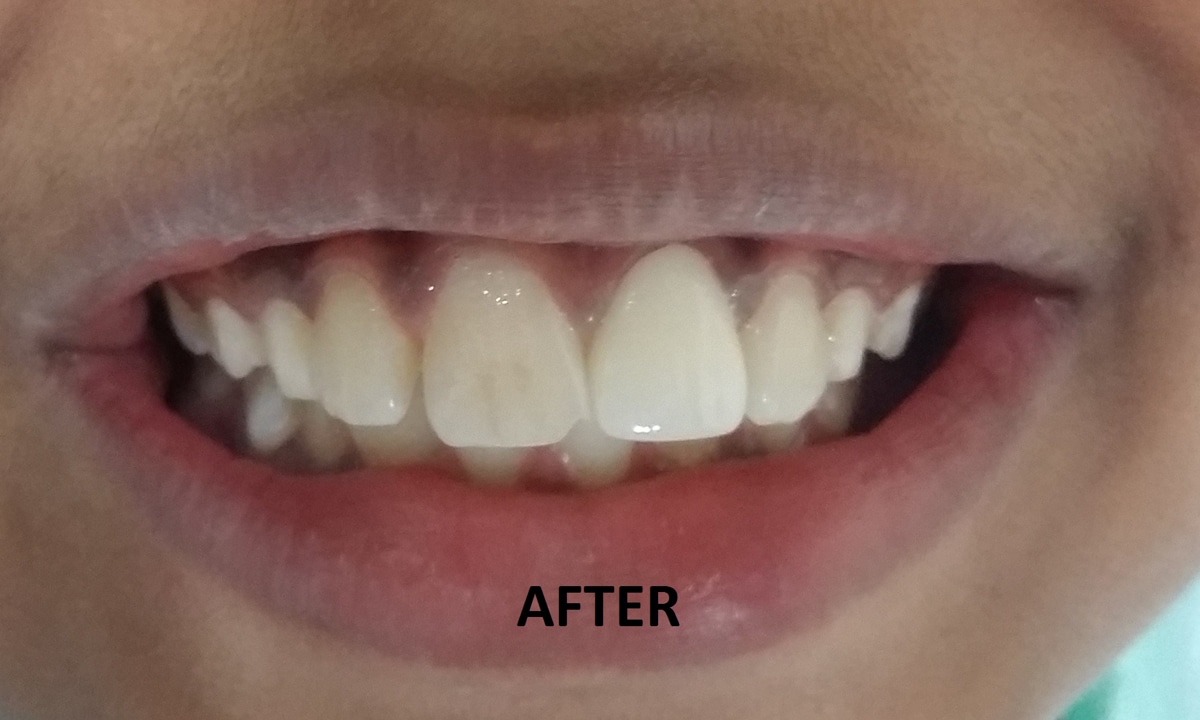 Crown Bridge AFTER Dr Ahuja Dental and Implant Clinic Indirapuram Vaishali Vasundhara Ghaziabad Noida Delhi NCR 1