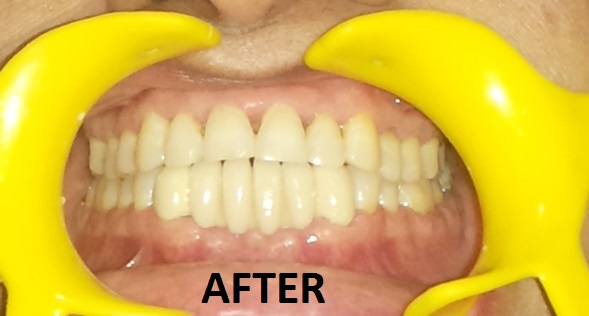 Crown Bridge case 3after Dr Ahuja Dental and Implant Clinic Indirapuram Vaishali Vasundhara Ghaziabad Noida Delhi NCR