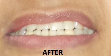 Crown Bridge case 4 after Dr Ahuja Dental and Implant Clinic Indirapuram Vaishali Vasundhara Ghaziabad Noida Delhi NCR