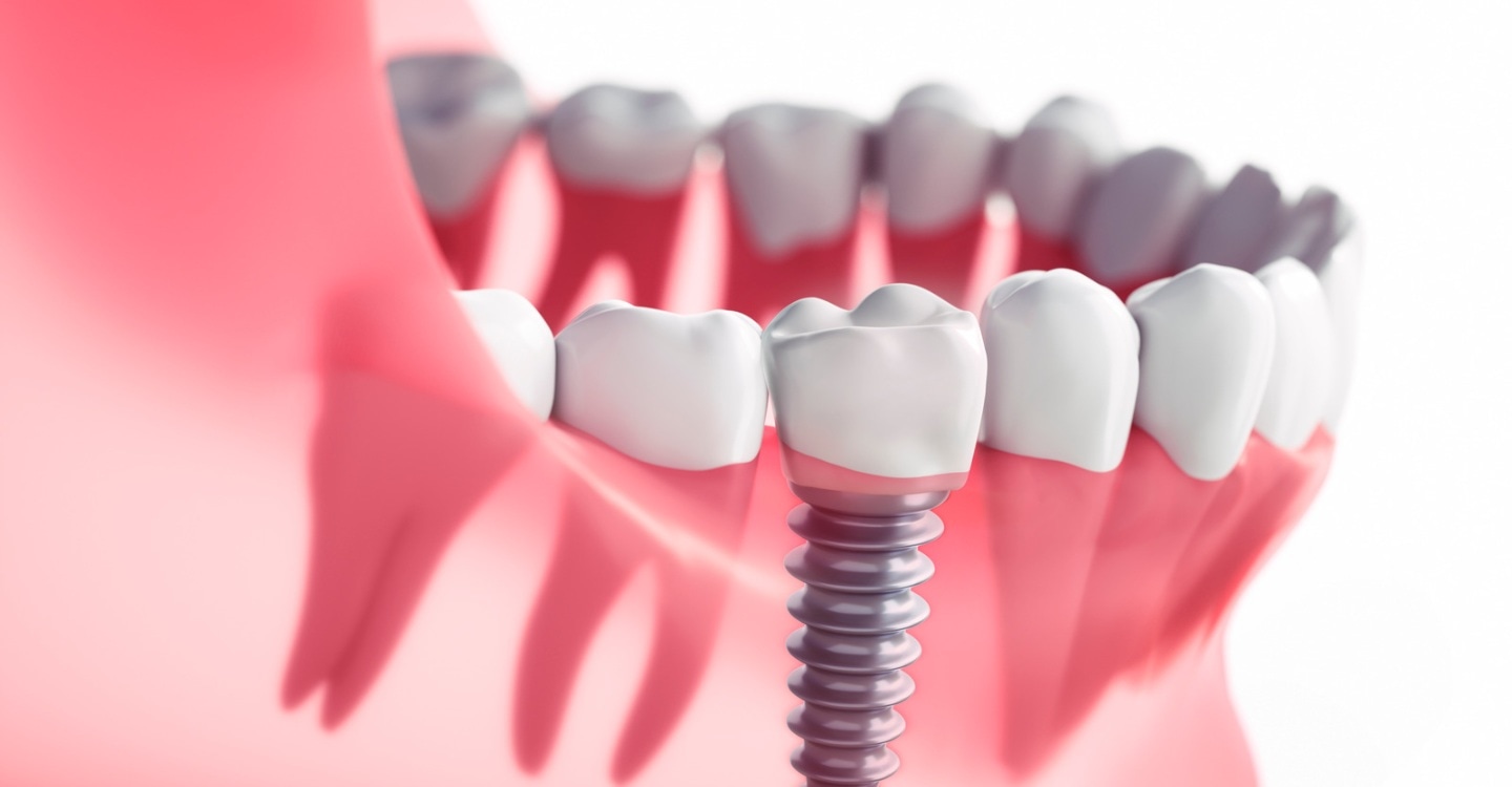 Dental Implant Services Dr. Ahujas Dental Service