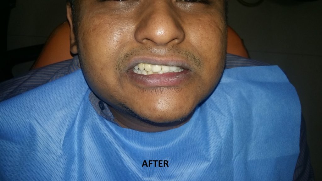 Dental Implants post 2 Dr Ahuja Dental and Implant Clinic Indirapuram Vaishali Vasundhara Ghaziabad Noida Delhi NCR