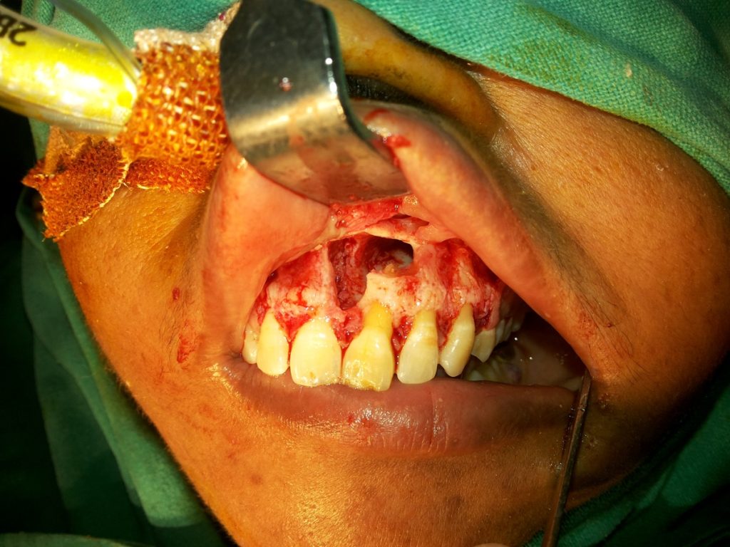 Oral and Maxillofacial Surgery Cyst removal Dr Ahuja Dental and Implant Clinic Indirapuram Vaishali Vasundhara Ghaziabad Noida Delhi NCR