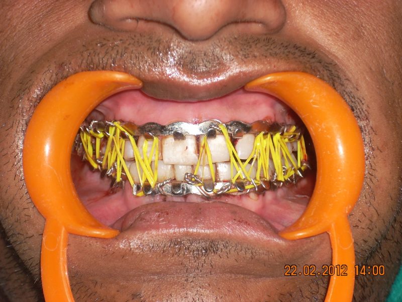 Oral & Maxillofacial Surgery Dr. Ahuja's Dental & Implant Clinic