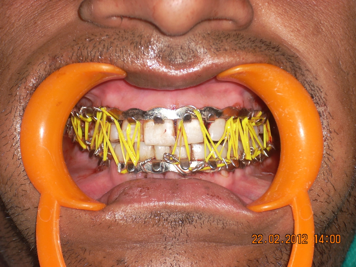 Oral & Maxillofacial Surgery Dr. Ahuja's Dental & Implant Clinic