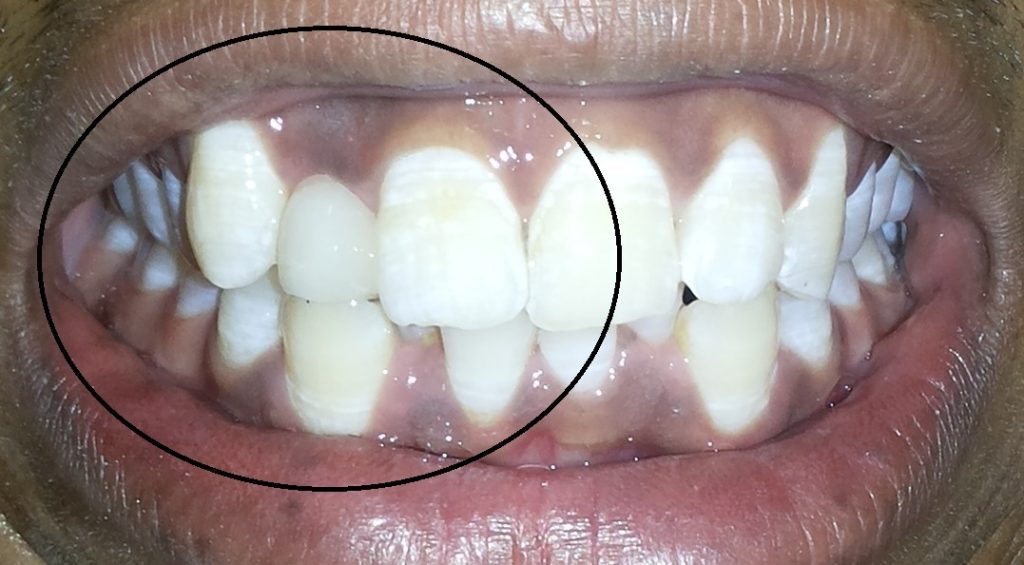 Post Cosmetic Filling Second to be put in Cosmetic dentistry section Dr Ahuja Dental and Implant Clinic Indirapuram Vaishali Vasundhara Ghaziabad Noida Delhi 1