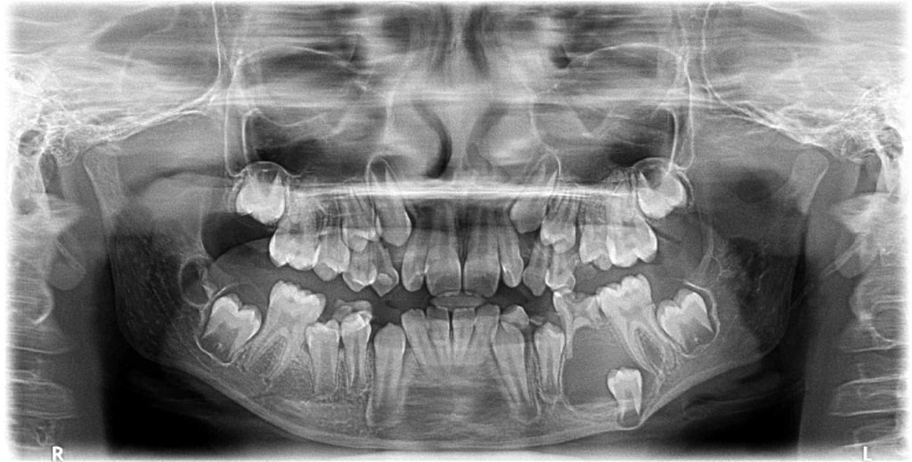 Radiology Case 5 full mouth xray showing multiple cysts Dr Ahuja Dental and Implant Clinic Indirapuram Vaishali Vasundhara Ghaziabad Noida Delhi NCR