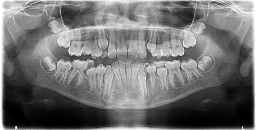 Radiology Kids full mouth xray showing erupting permanent teeth Dr Ahuja Dental and Implant Clinic Indirapuram Vaishali Vasundhara Ghaziabad Noida Delhi NCR