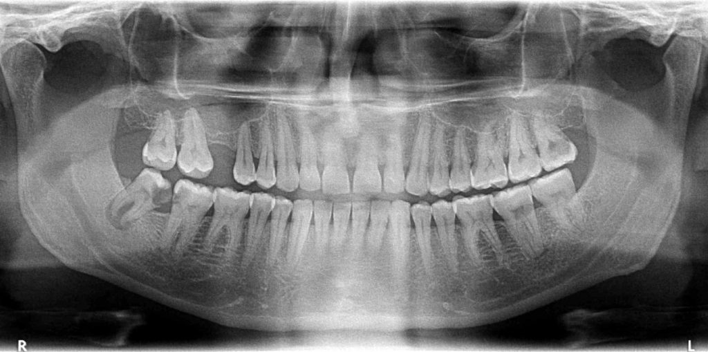 Radiology Xray showing Severly decayed lower left last teeth Dr Ahuja Dental and Implant Clinic Indirapuram Vaishali Vasundhara Ghaziabad Noida Delhi NCR
