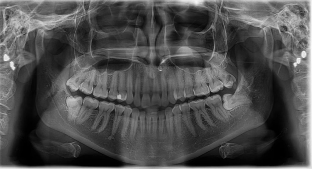 Radiology Xray showing impaction of lower right wisdomm teeth Dr Ahuja Dental and Implant Clinic Indirapuram Vaishali Vasundhara Ghaziabad Noida Delhi NCR