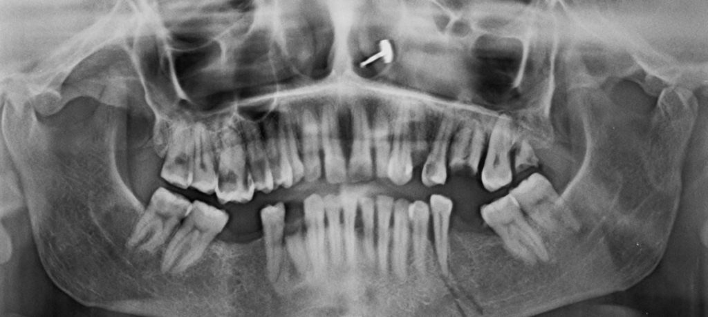 Radiology mandibular fracture in left lower side Dr Ahuja Dental and Implant Clinic Indirapuram Vaishali Vasundhara Ghaziabad Noida Delhi NCR