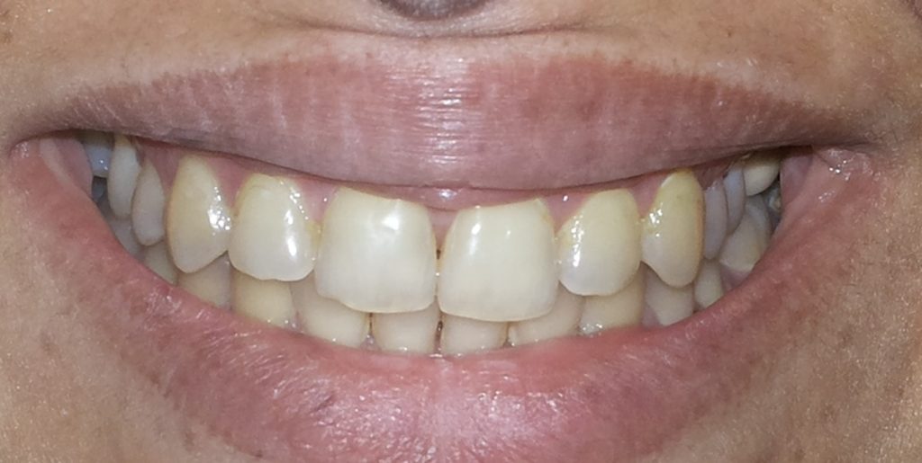 pre Bleaching cosmetic dentistry Dr Ahuja Dental and Implant Clinic Indirapuram Vaishali Vasundhara Ghaziabad Noida Delhi NCR 2