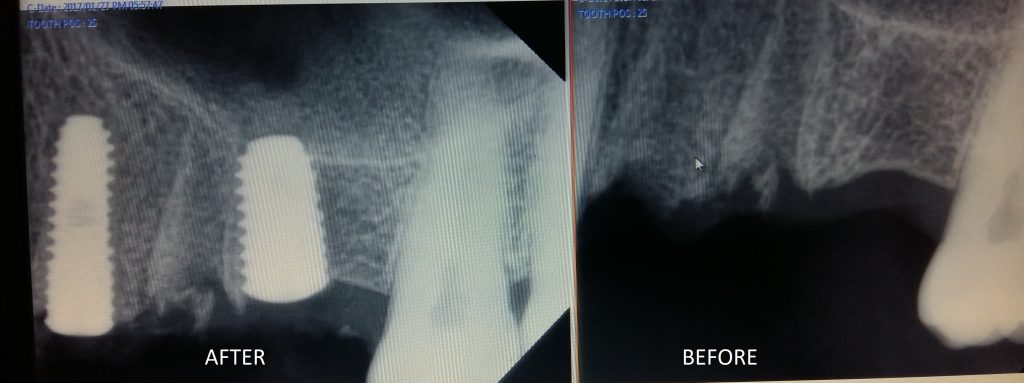 xray comparison to be places in the end of this case case 1 dental implant