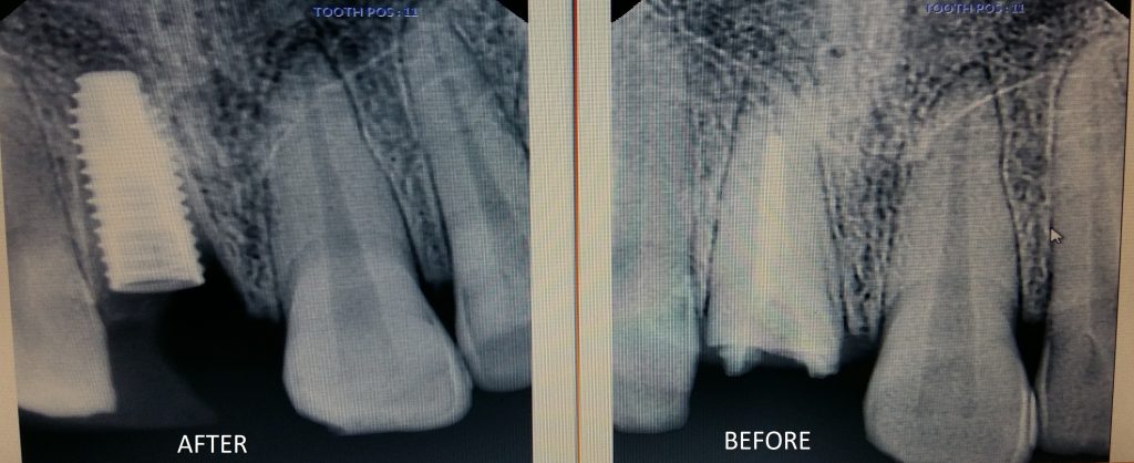 xray comparison to be places in the end of this case case 2 dental implant